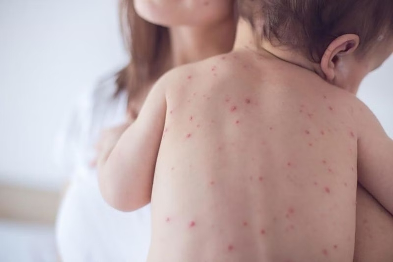 vắc xin sởi - quai bị - rubella