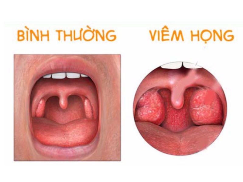 viêm họng cấp ở trẻ