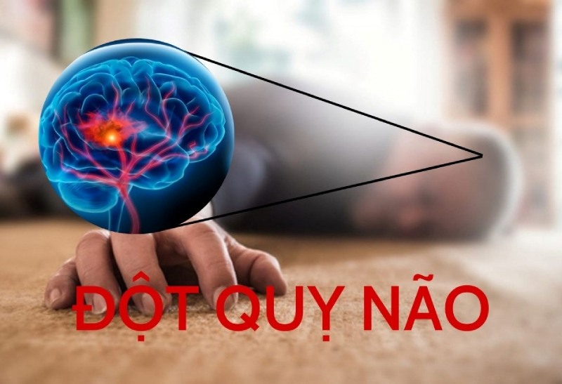 đột quỵ não