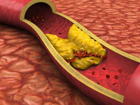 tắc động mạch vành