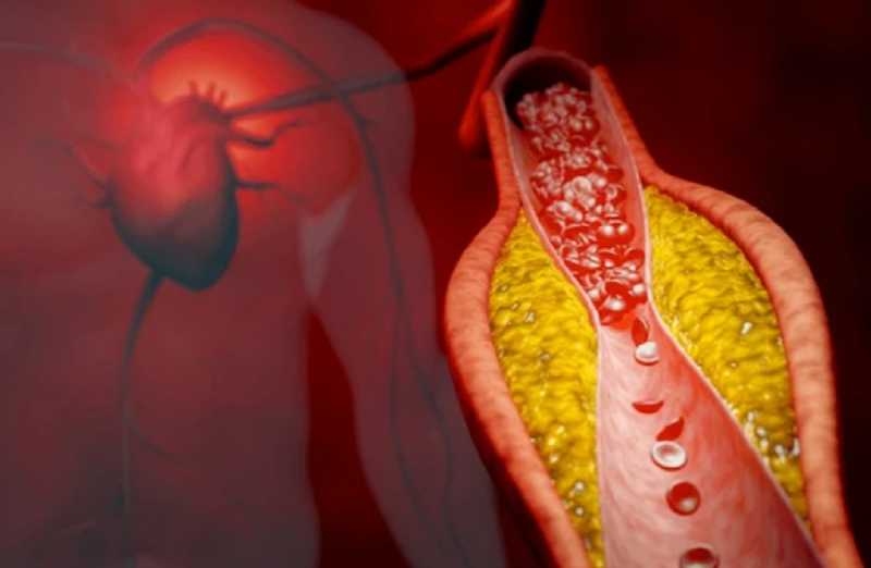 nguyên nhân suy mạch vành